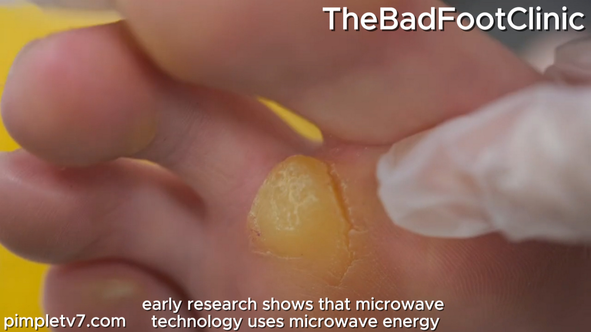 Aaron suffers from the rare genetic condition, causing them constant pain. TheBadFootClinic 280826