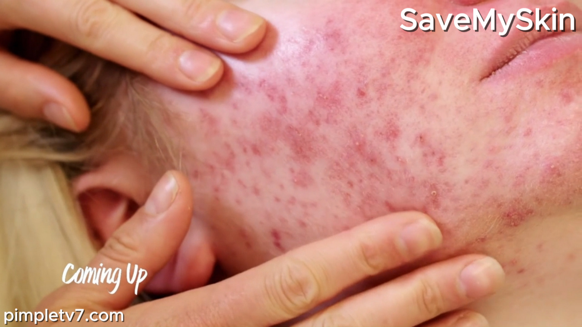 Abigail’s acne has run unchecked for years. SaveMySkin 310726