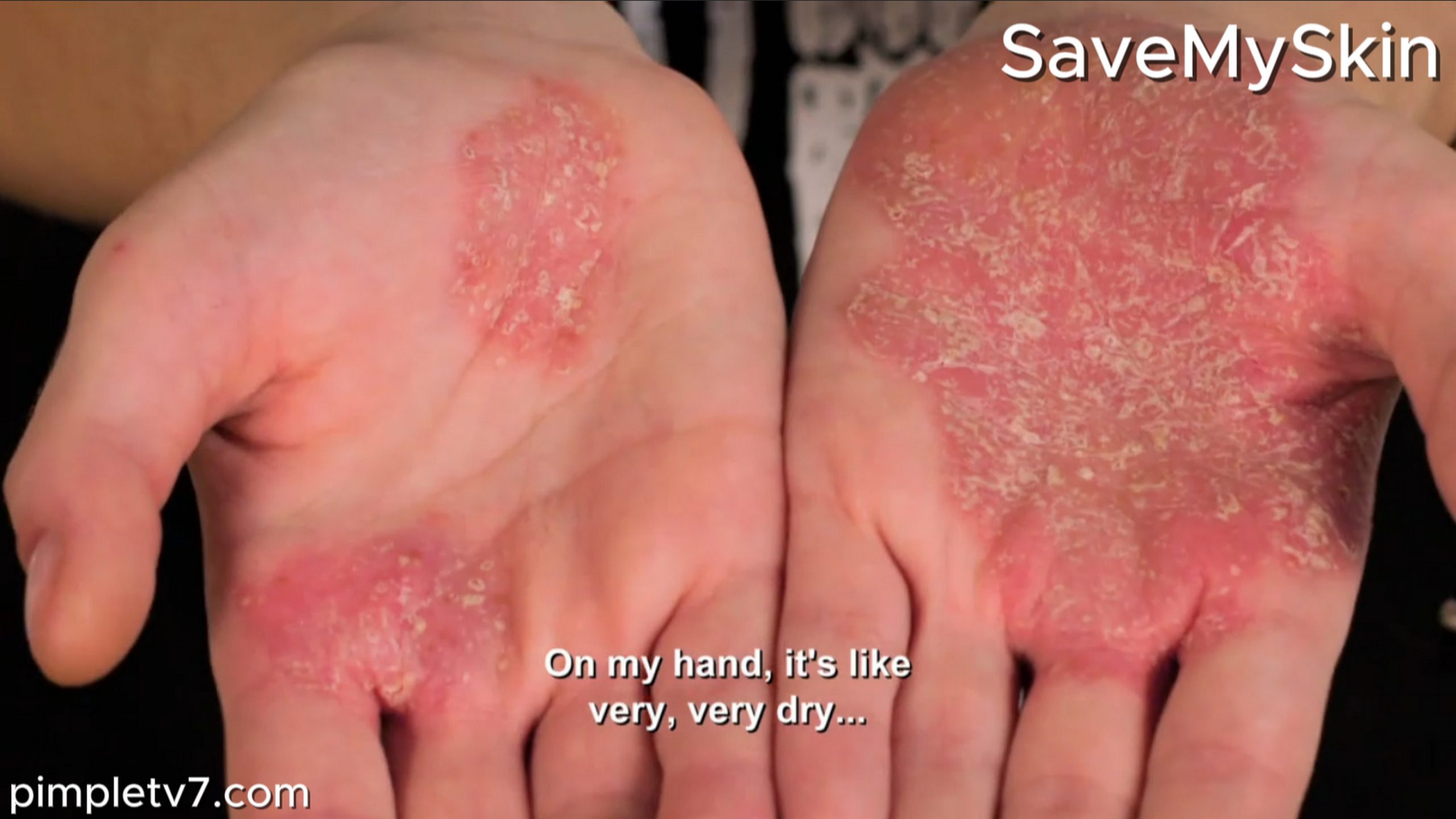 Abigail’s scaly skin is spreading from limb to limb. SaveMySkin 200826
