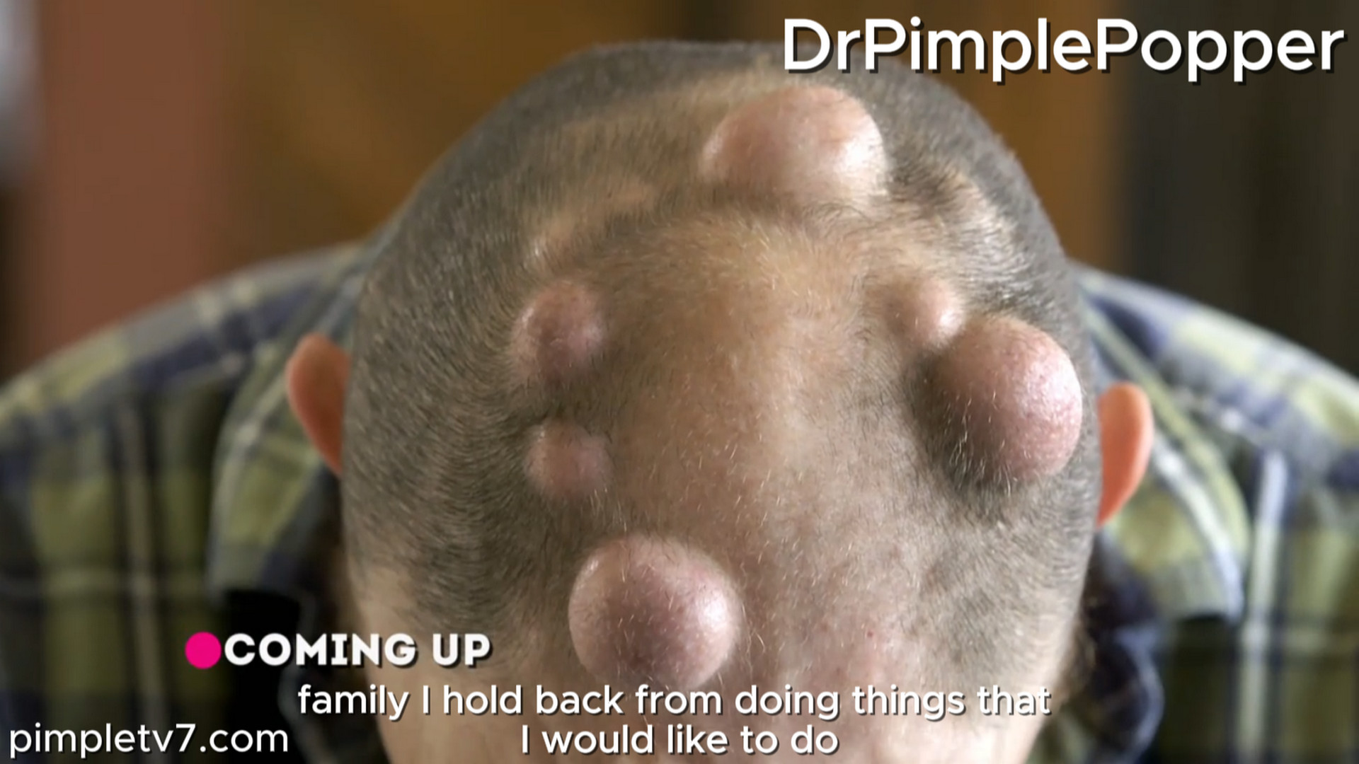 Adam has a semi-circle of about a dozen cysts on his head that he covers with a hat. Dr. Pimple Popper 100826