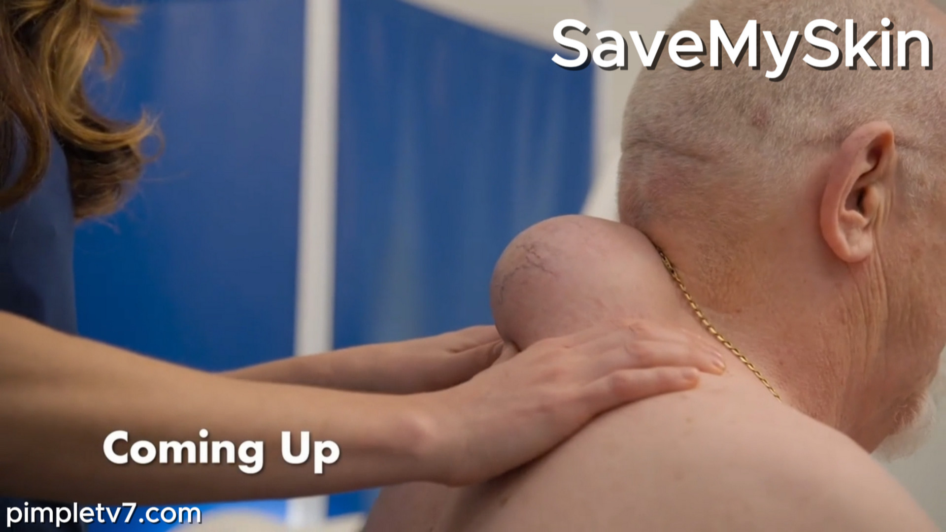 Alan has a massive lipoma on his back. SaveMySkin 230826