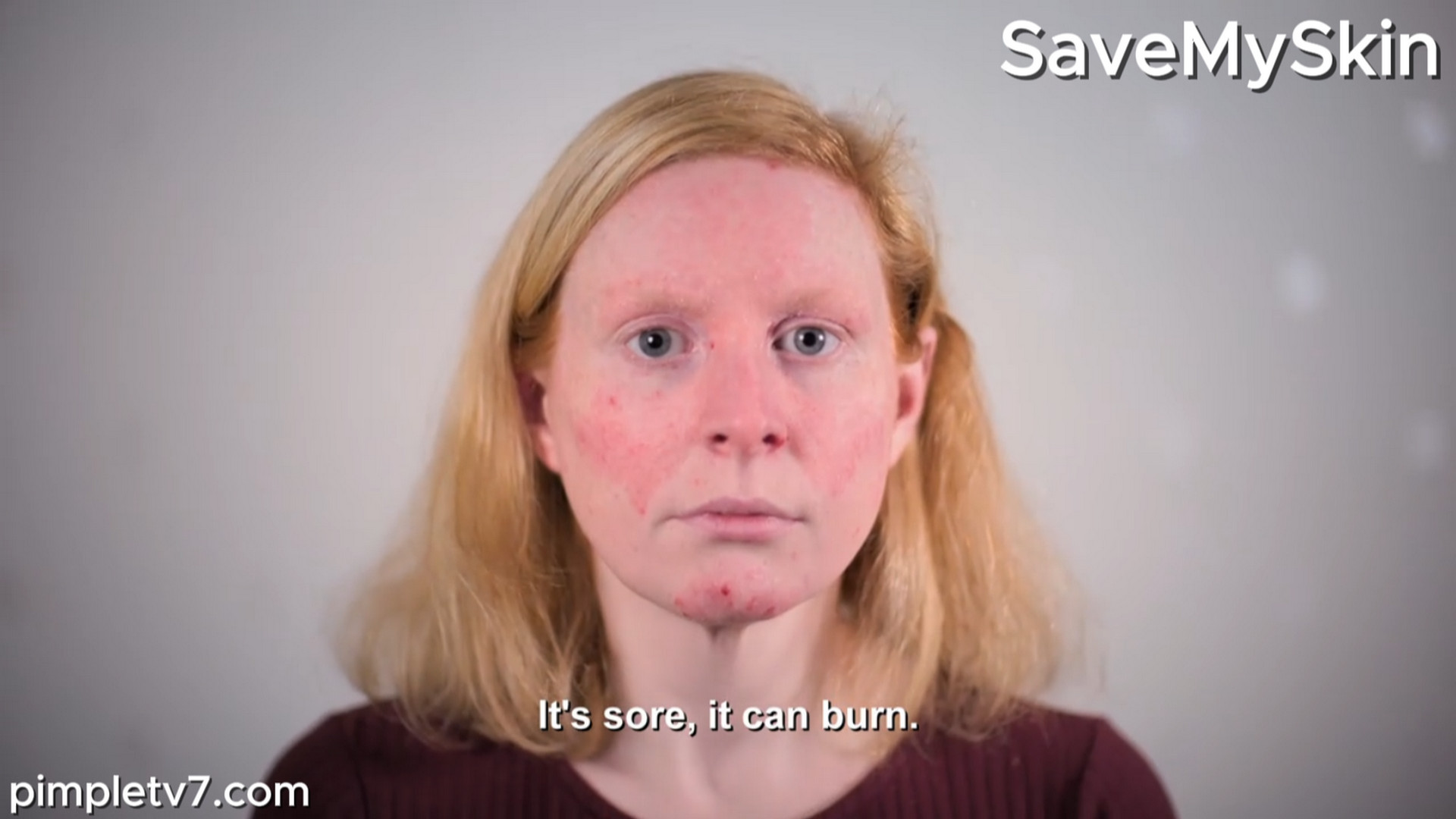 Ally has a rare skin condition. SaveMySkin 150826