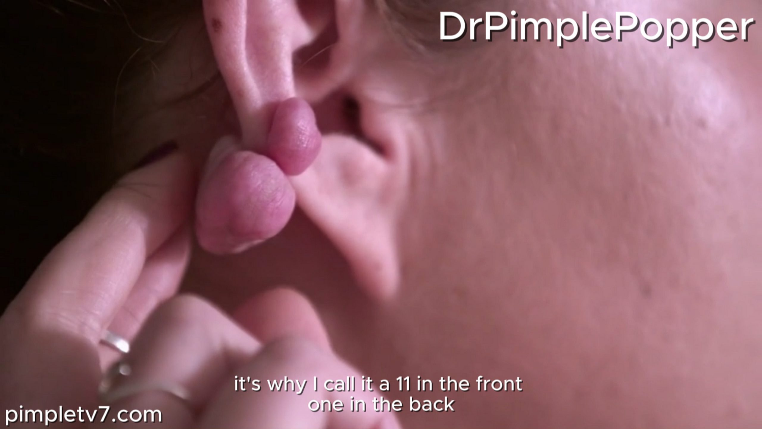 Amber has ear keloids that have taken control of her life. Dr. Pimple Popper 270826