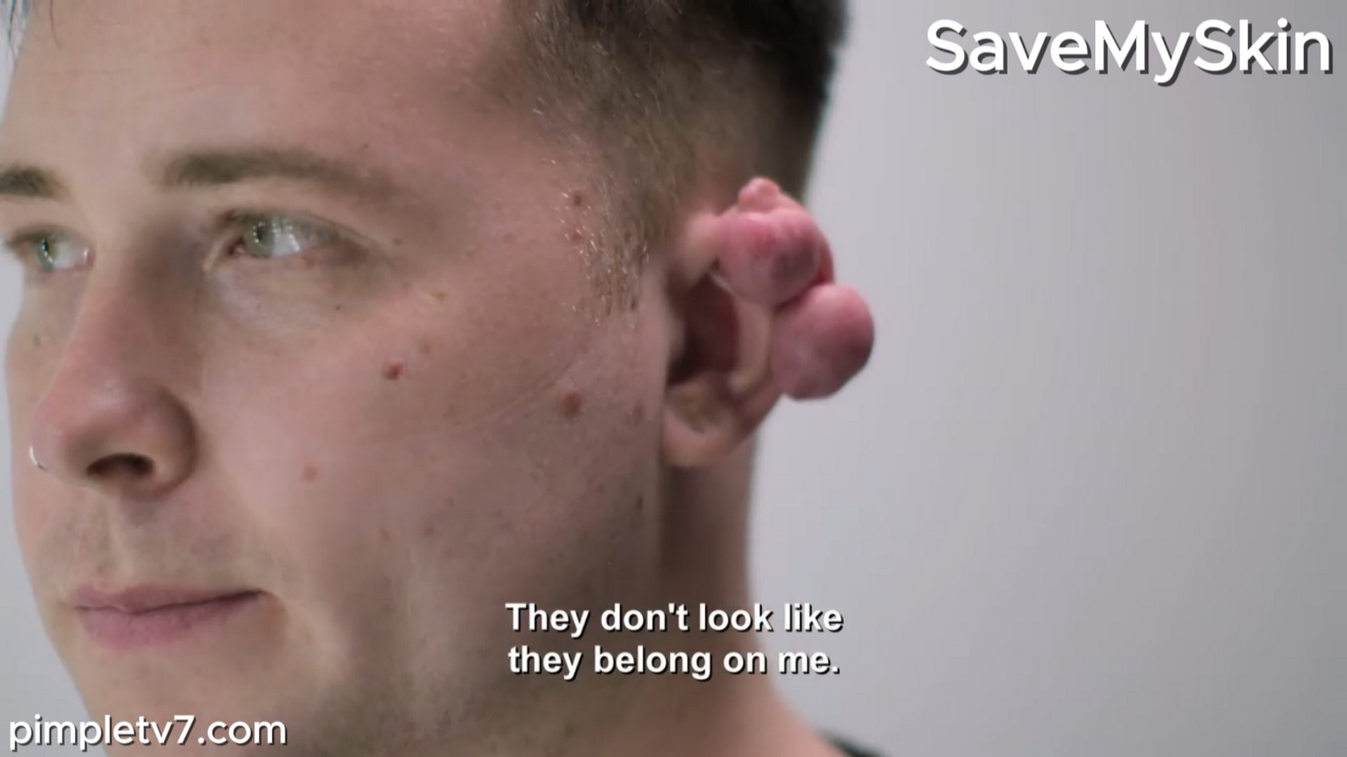 Antony’s keloids are preventing him from dating. SaveMySkin 300826