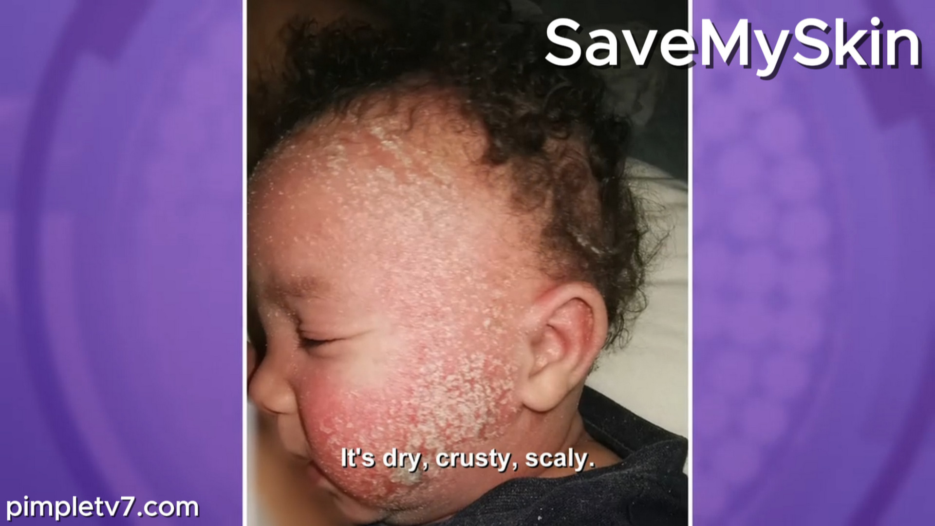Baby Emerick suffers from severe eczema. SaveMySkin 270826