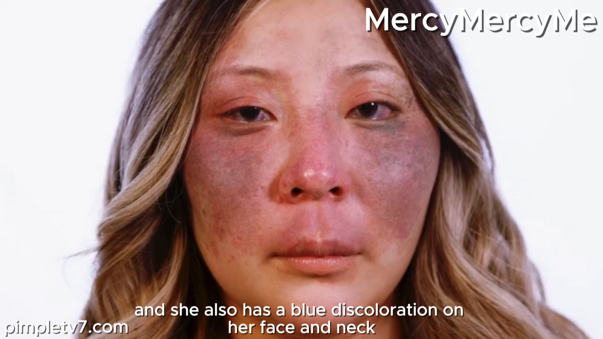Becca was born with a birthmark that covers the majority of her face. MercyMercyMe 180826