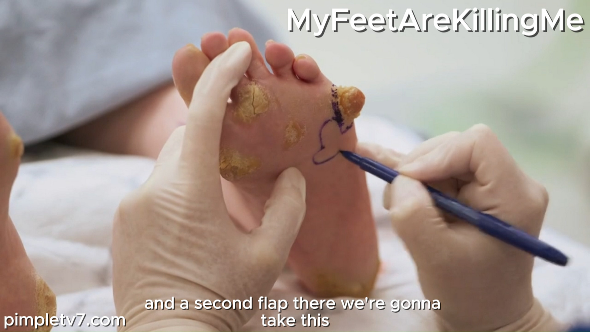 Bobbi suffers from the rare genetic condition, causing them constant pain. TheBadFootClinic 270826