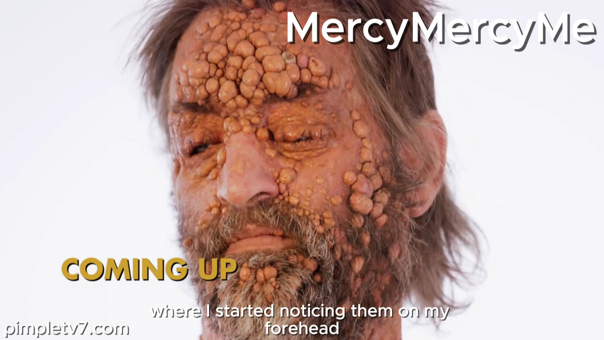 Brad’s face is covered in nodules from a condition that affects less than one in a million people. MercyMercyMe 200826