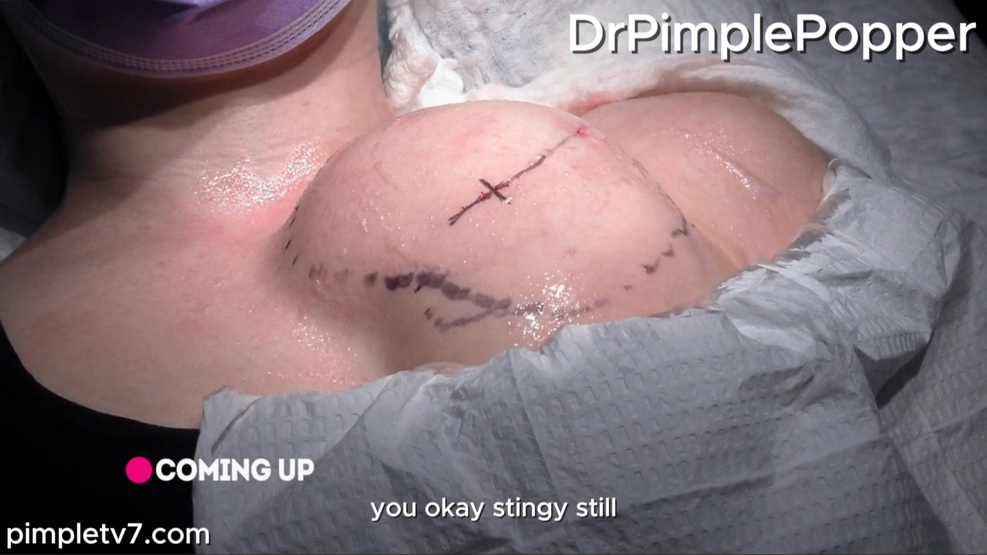 Brandi’s anxiety keeps her from getting a lump removed from her chest. Dr. Pimple Popper 300826