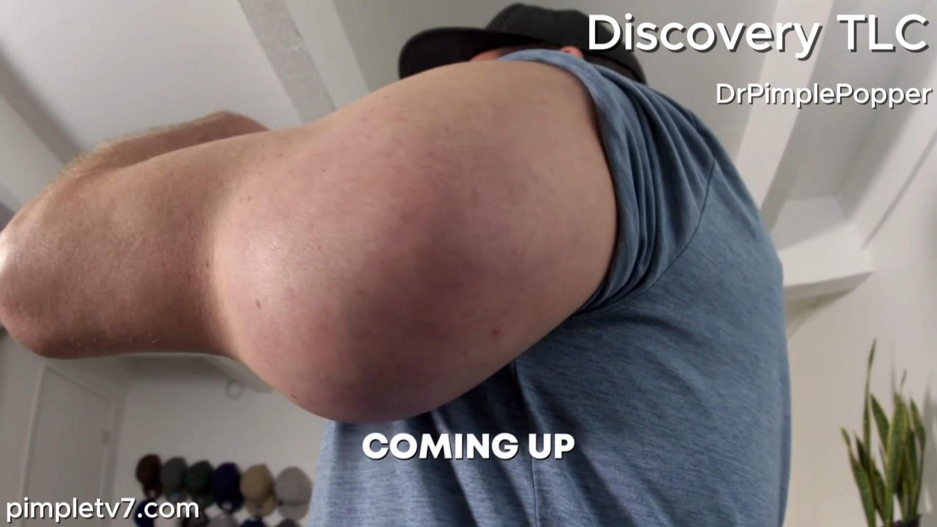 Brent has a tricep bump that could be intertwined with his muscle. Dr. Pimple Popper 090826
