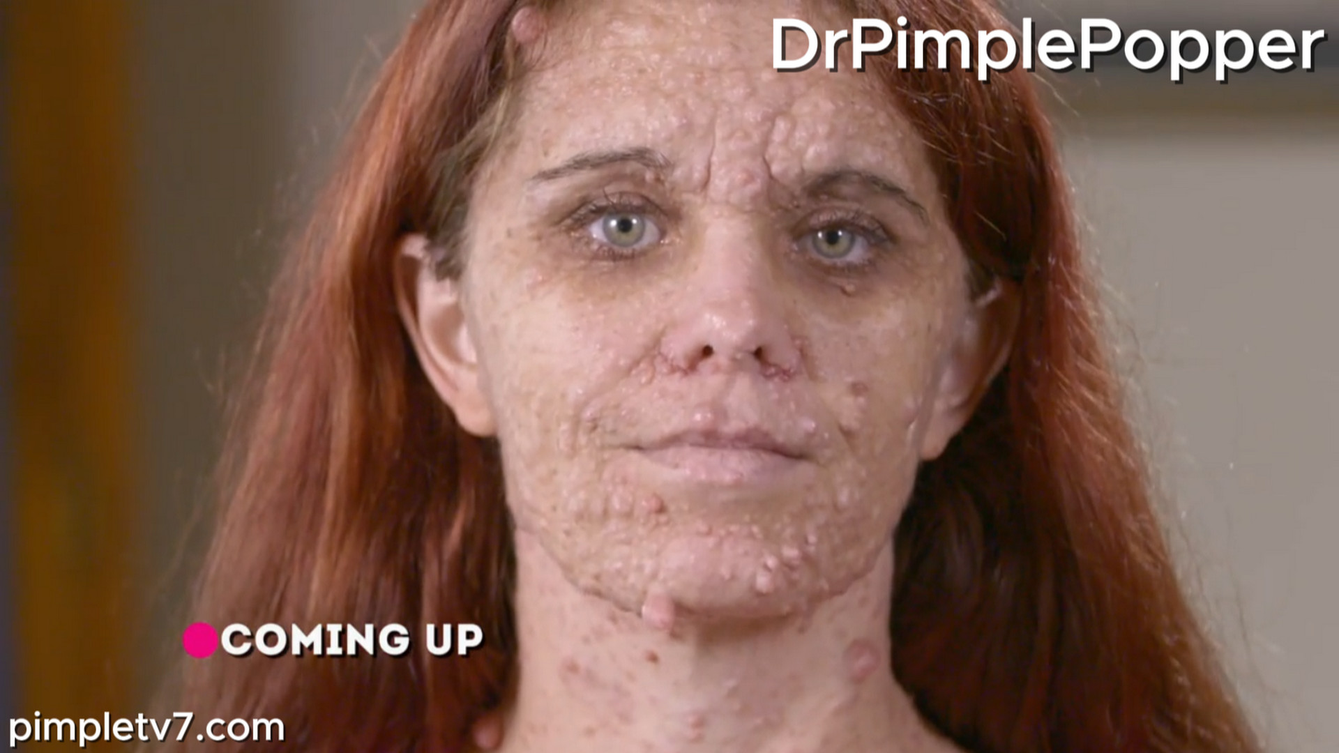 Brittany has been called a monster due to her genetic condition that causes head-to-toe bumps. Dr. Pimple Popper 070826
