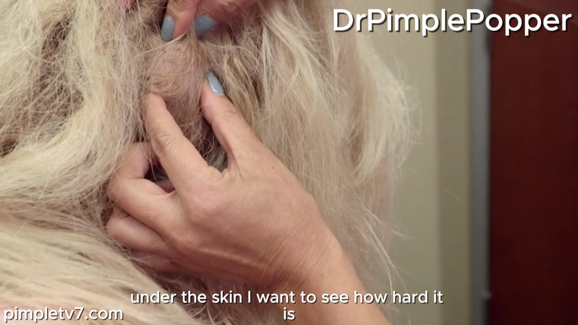 Carla looks to have five cysts removed. Dr. Pimple Popper 150826