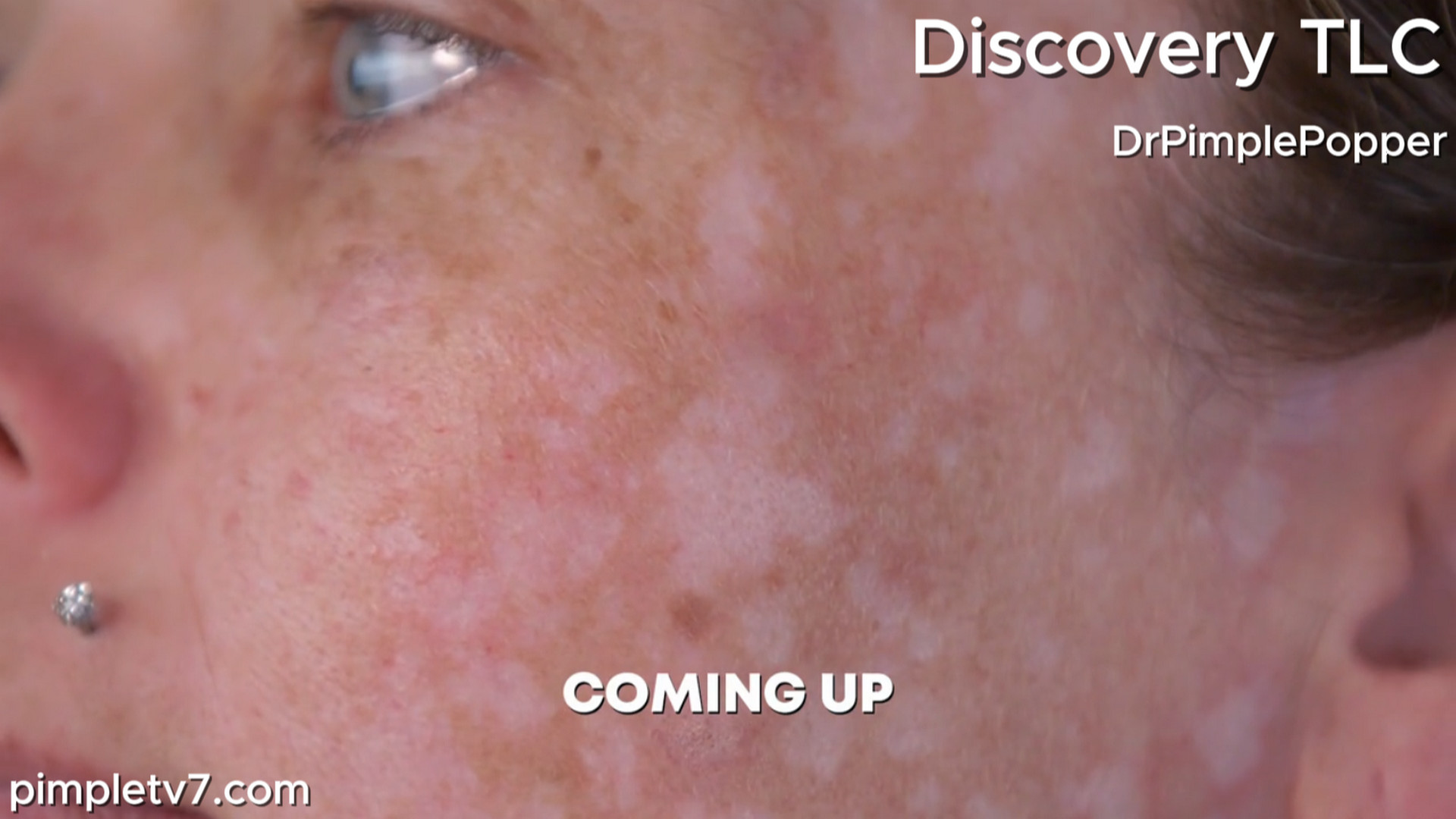 Cherish developed a leopard-print face during pregnancy. Dr. Pimple Popper 090826