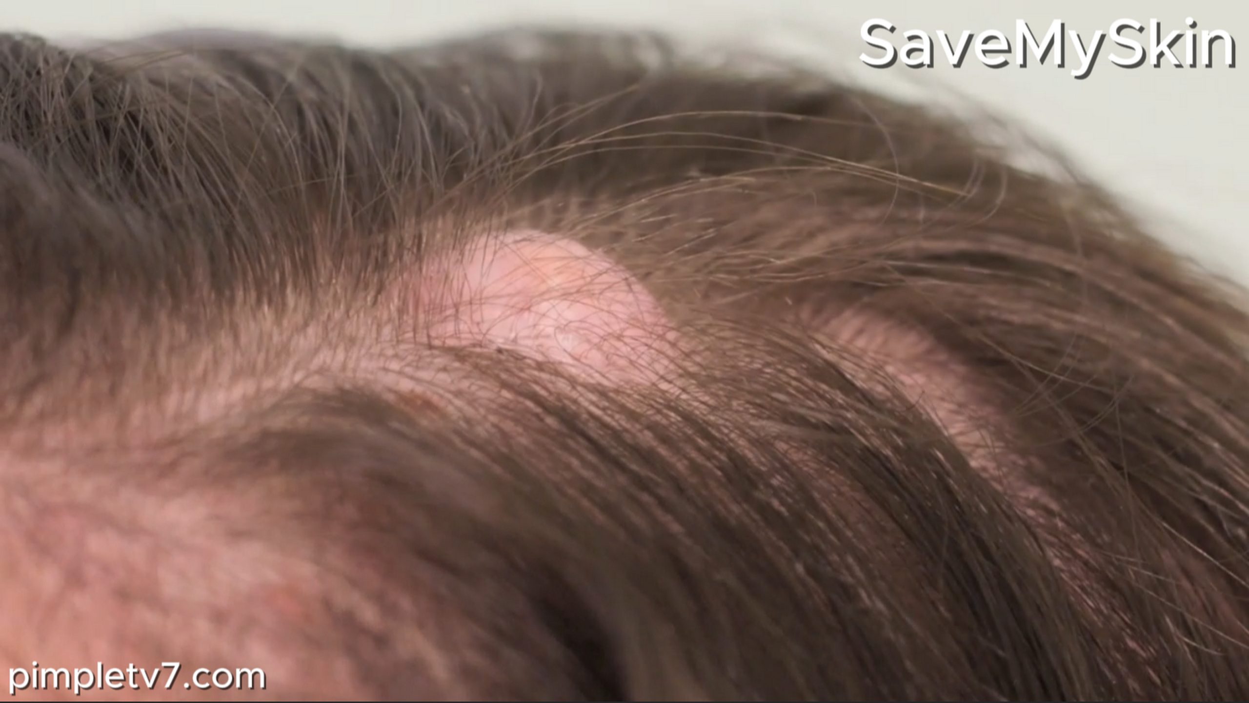 Chloe hopes Dr. Emma can remove the cysts from her head. SaveMySkin 150826