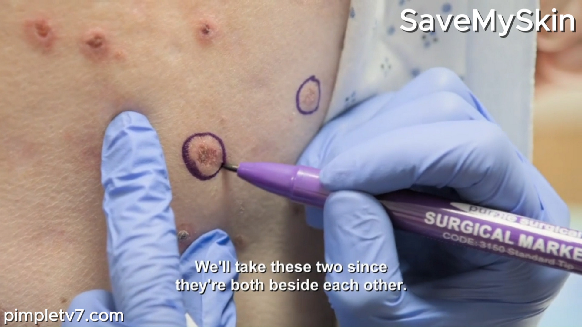 Chris has been suffering with itchy, pus-filled lesions that cover his entire body. SaveMySkin 170826