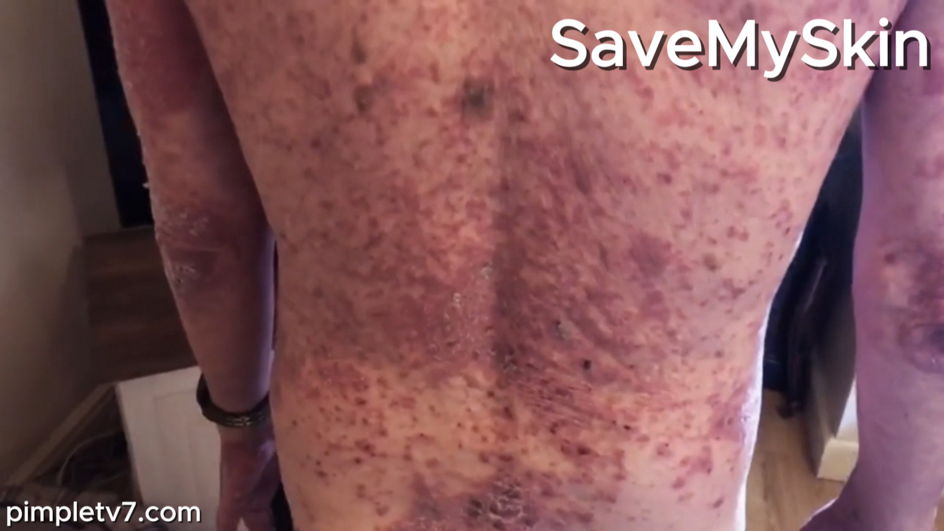 Chris’ psoriasis puts a strain on his marriage. SaveMySkin 290826