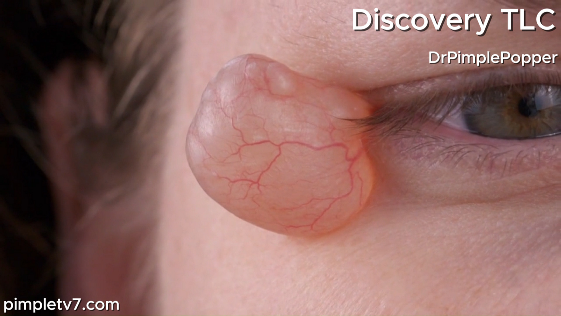 Christina has big, veiny, liquid-filled balloons next to her eyes. Dr. Pimple Popper 060826