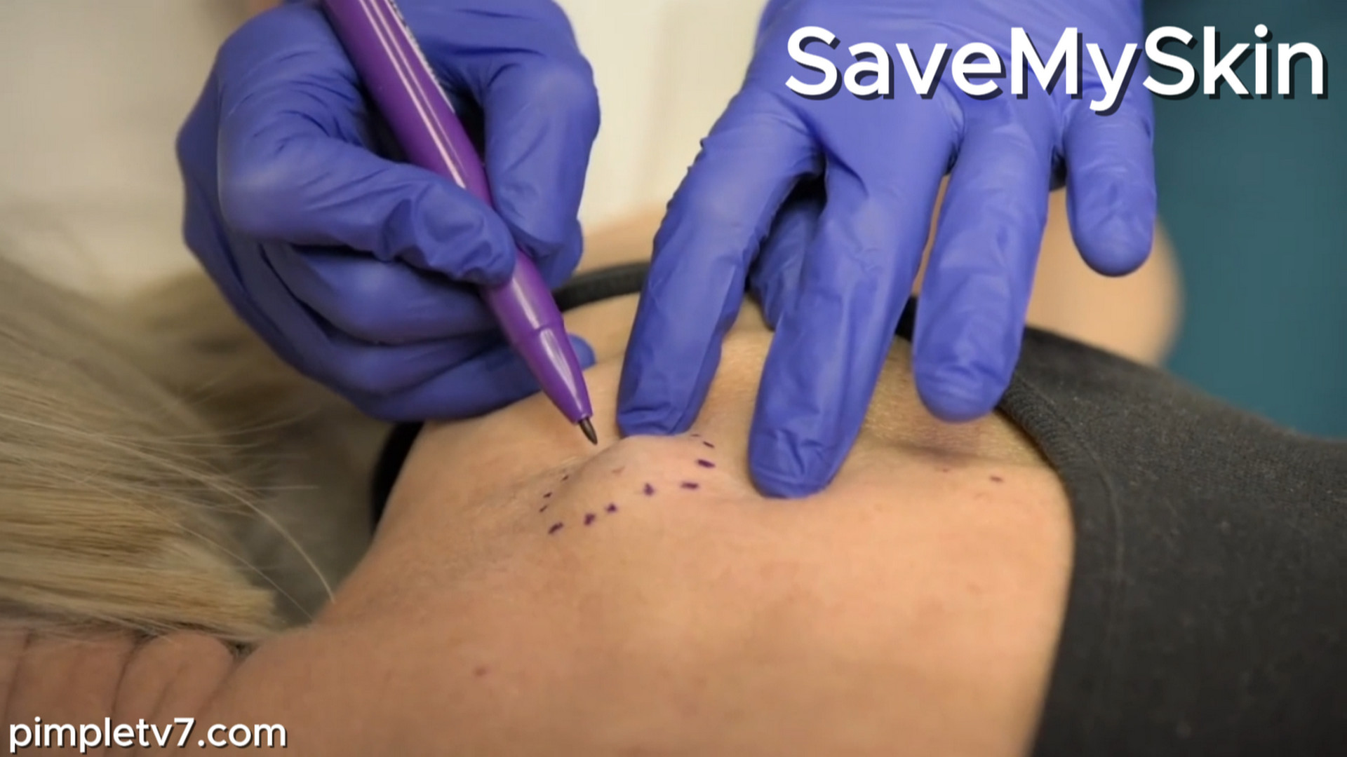 Christine would like her cyst removed before her son’s wedding. SaveMySkin 230826