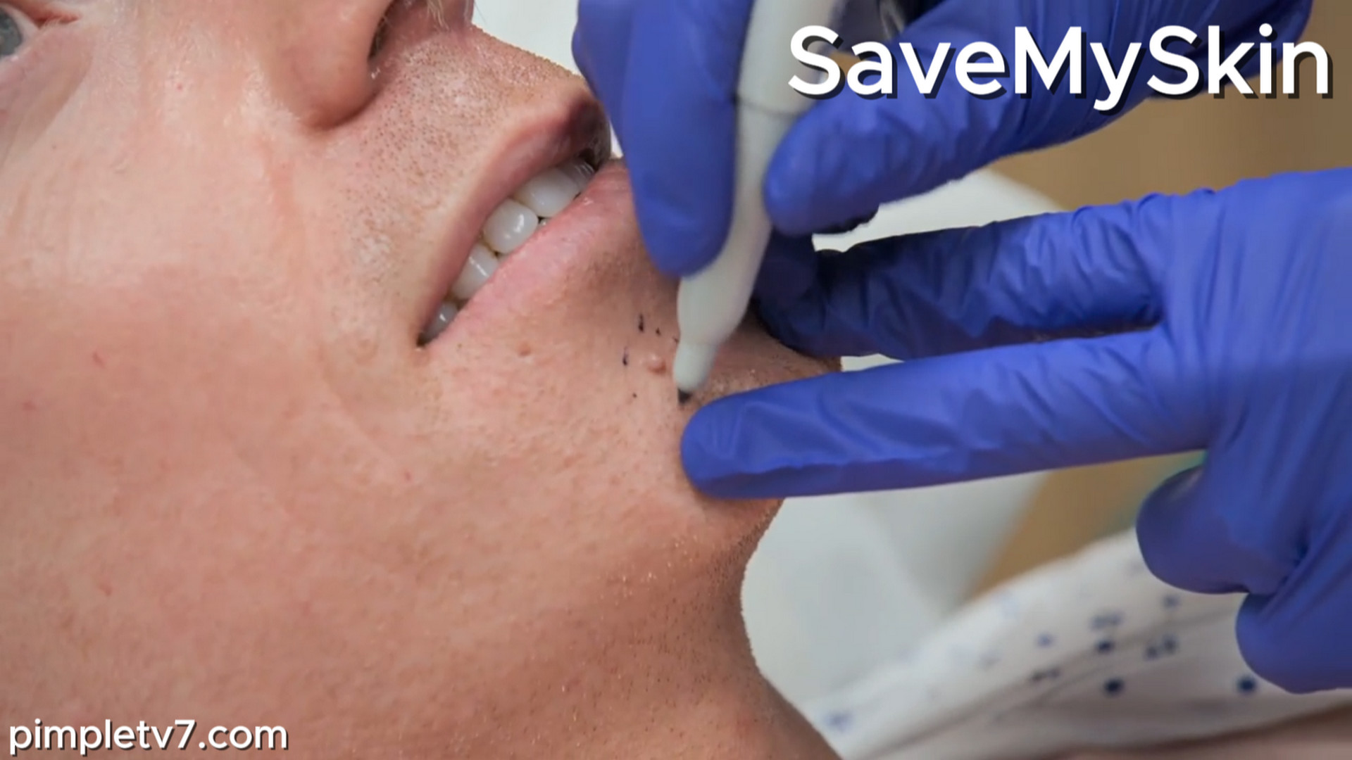 Ciaran has small tumors growing all over his body. SaveMySkin 310826