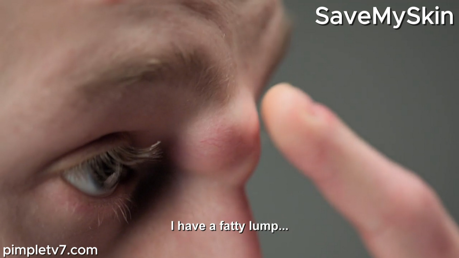 Connor has a lump on his forehead that has stunted his social life. SaveMySkin 280826