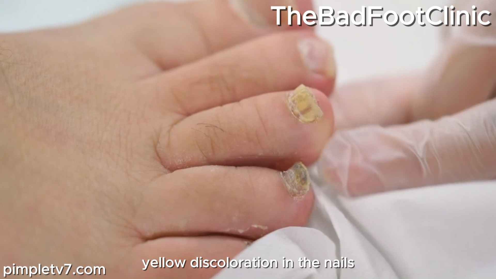 Craig, it started about 25 years ago; it developed into, like, a foot fungus. TheBadFootClinic 140826