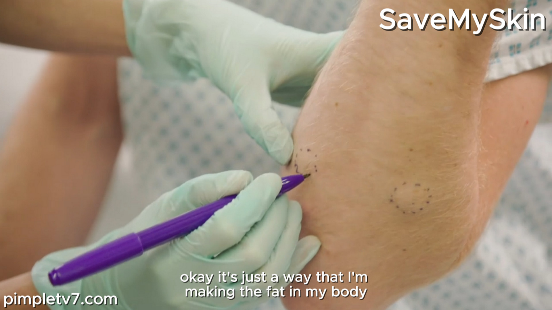 Dave has a lot of cysts on his arm and his body that Dr. Emma has seen. SaveMySkin 220826