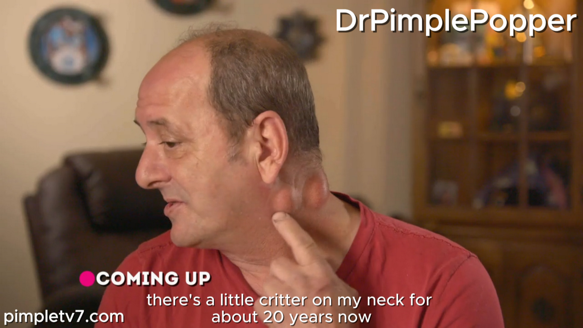 David has two bumps on his neck and one on his finger that give him pain. Dr. Pimple Popper 030826