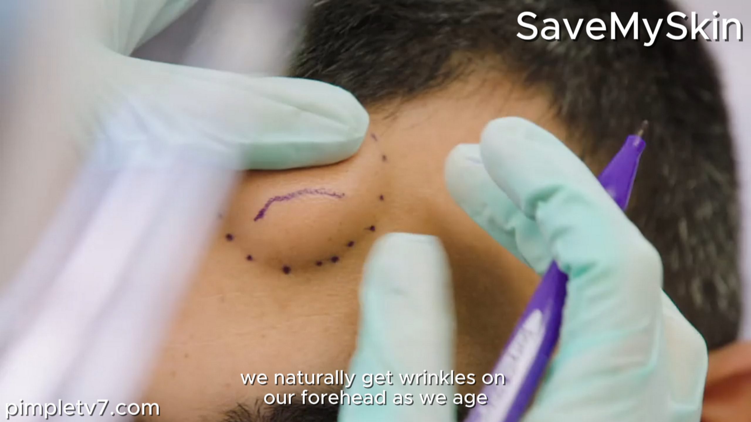 David hopes Dr. Emma can remove the lipomas on his head. SaveMySkin 200826