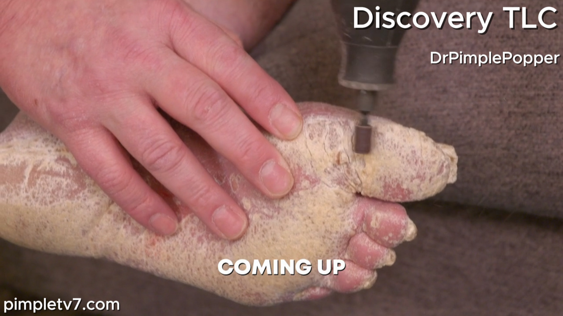 Don has a case of crippling psoriasis that has completely taken over his body. Dr. Pimple Popper 110826