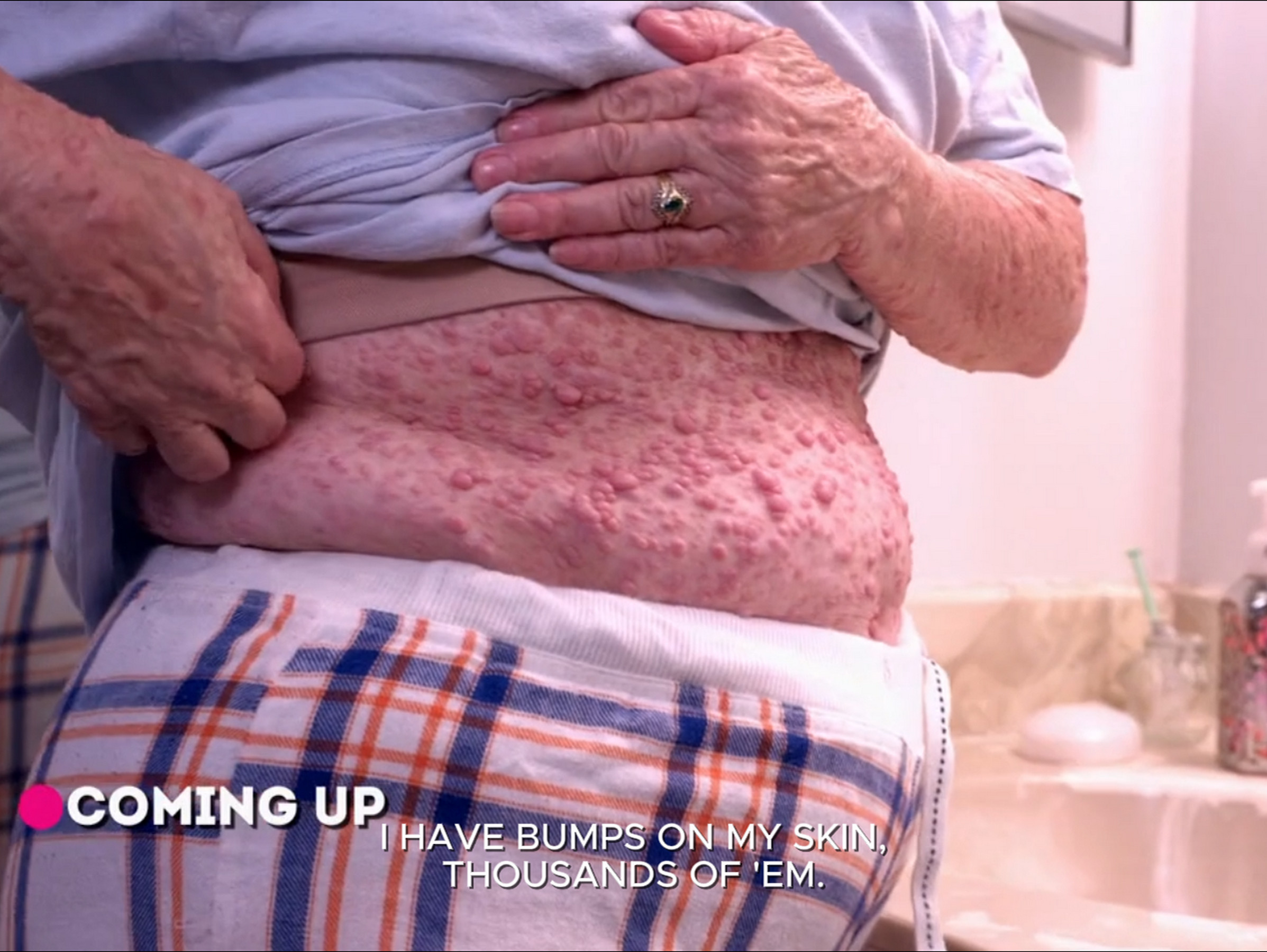 Dr. Sandra Lee assists Diane, who has thousands of tumors all over her body, ruining her life. Dr. Pimple Popper 300826