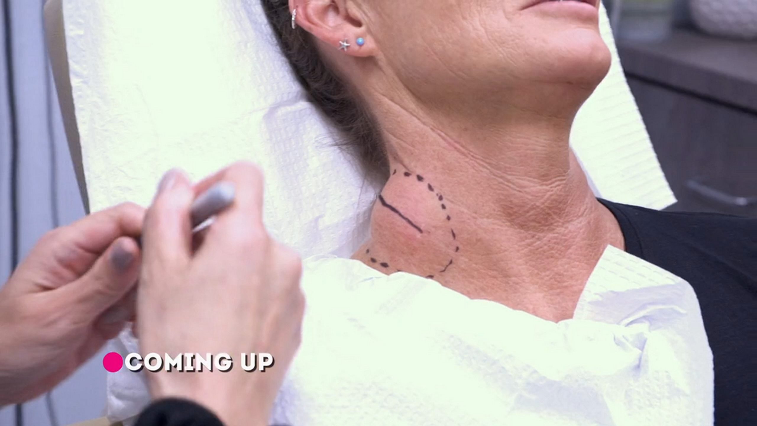 Sandy, who has had a large lump on her neck for five years. Dr. Pimple Popper 310826