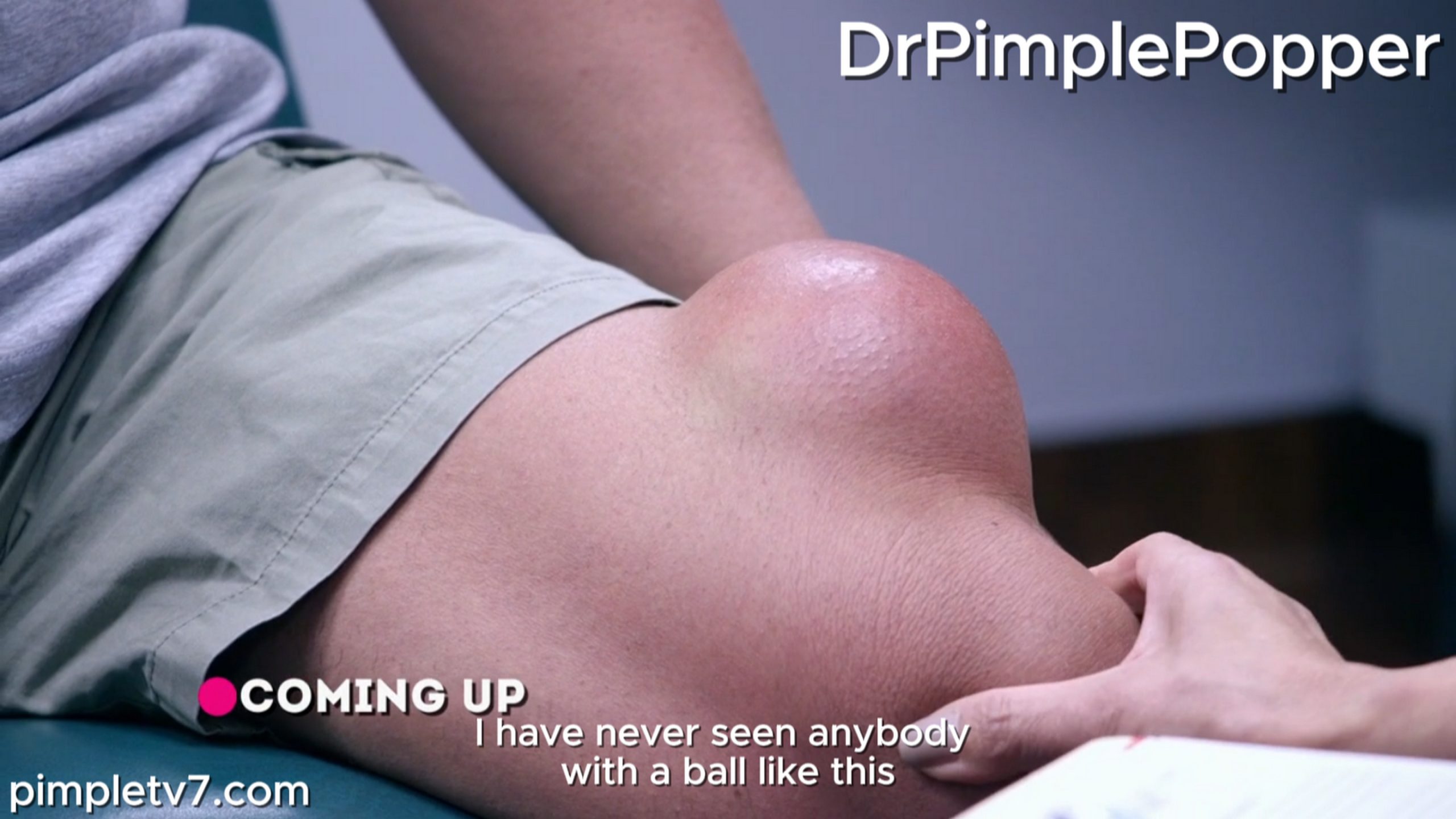 Dr. Sandra Lee assists patients, including Ronen, whose lump above his knee is one of the largest she has ever seen. Dr. Pimple Popper 280826