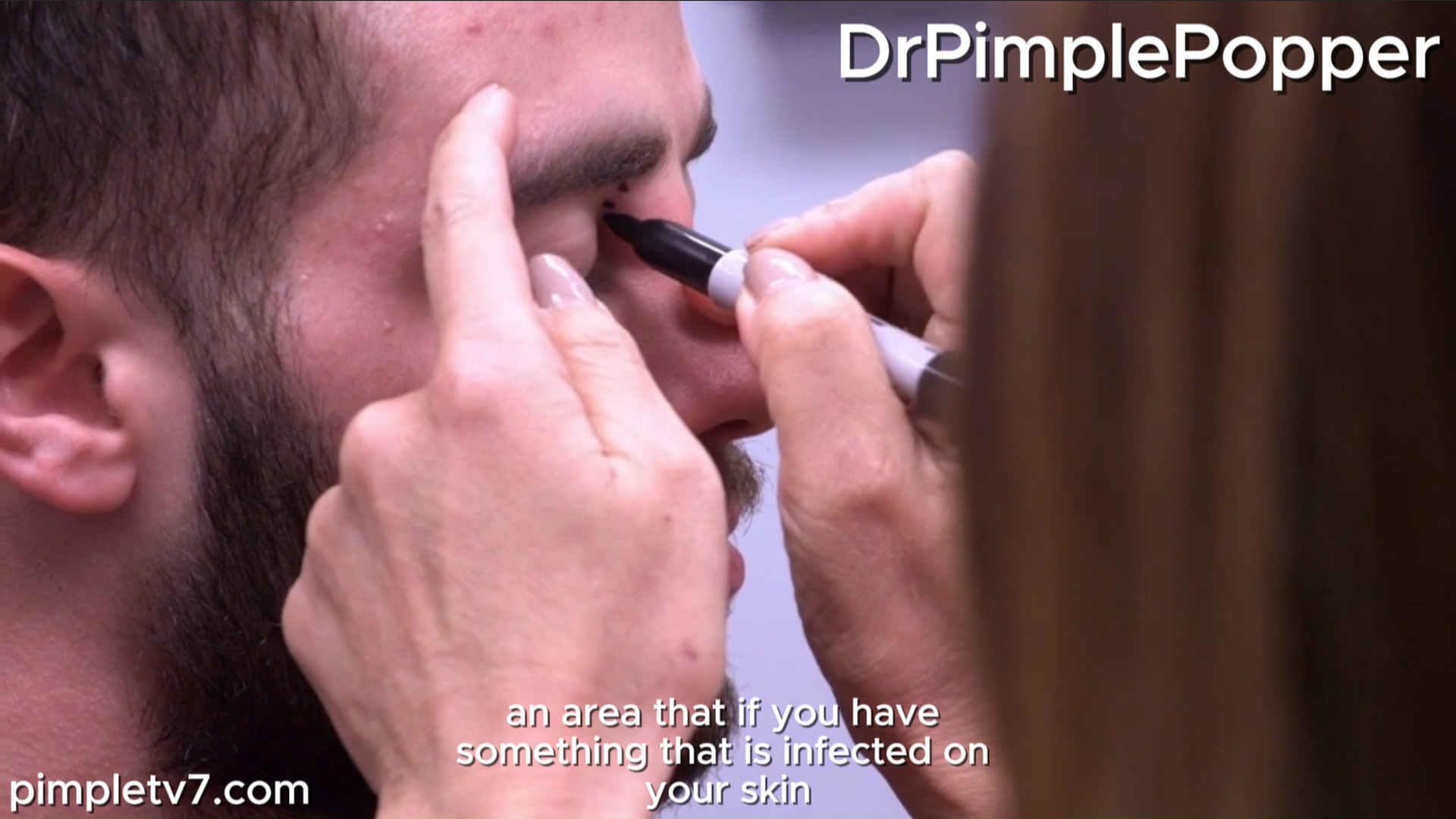 Dr. Sandra Lee helps Anthony, who has a facial cyst in an area called the triangle of death. Dr. Pimple Popper 290826
