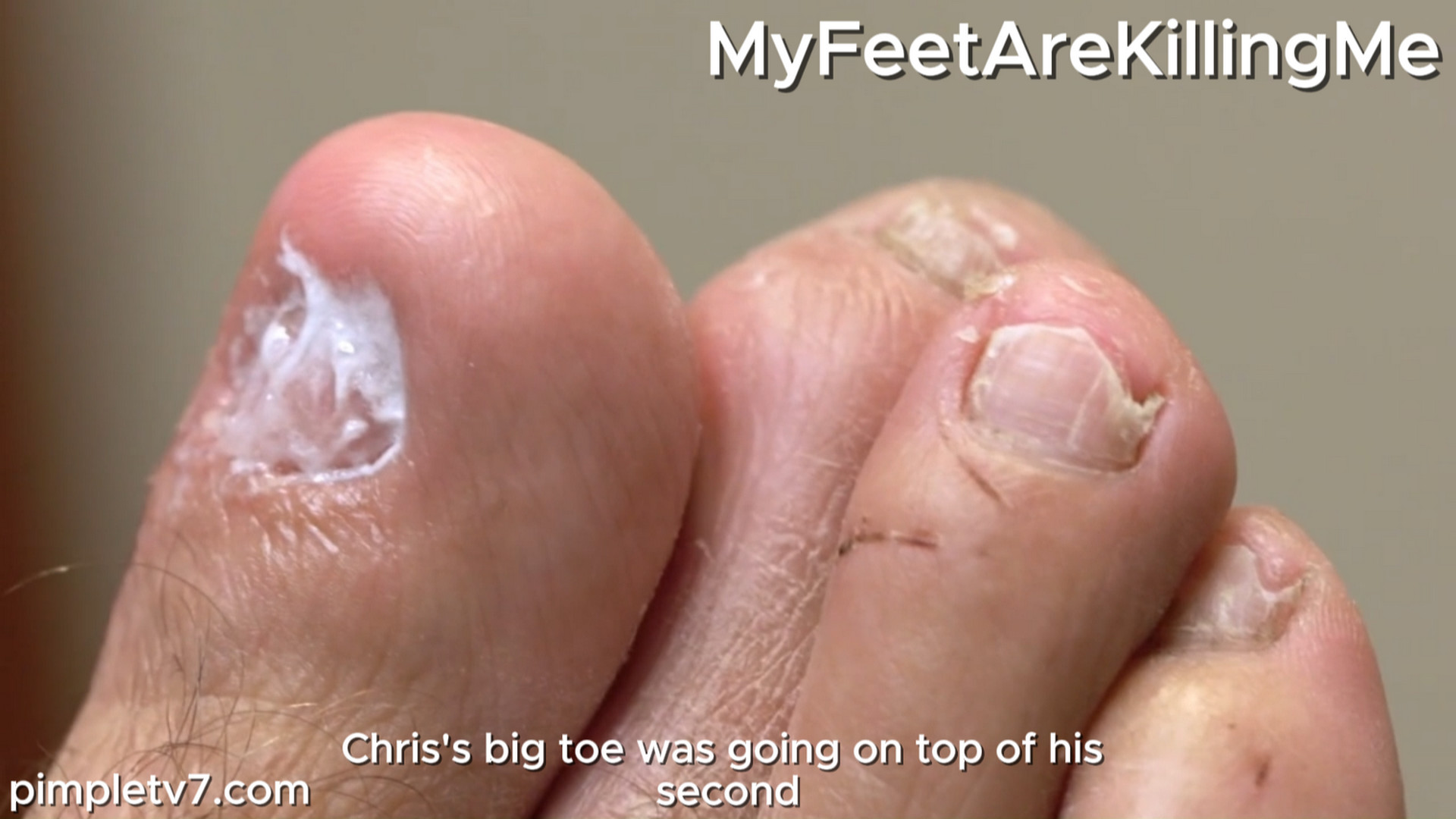 Dr. Schaeffer meets a nudist with funky feet. MyFeetAreKillingMe 260826