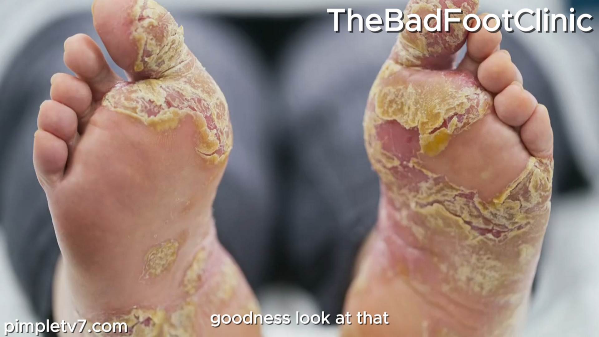 Drew has got an issue with his right foot. It’s unsightly and embarrassing. TheBadFootClinic 150826