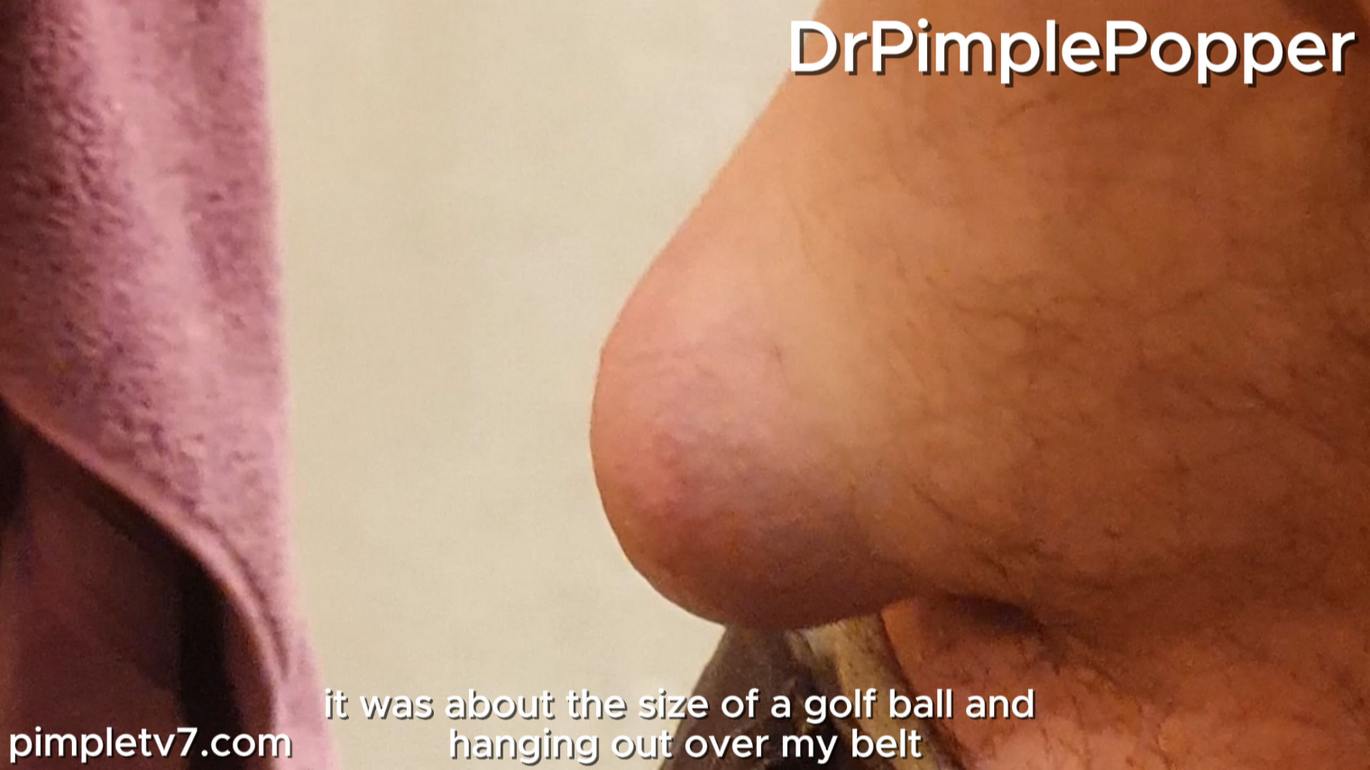 Ed wants his stomach lump removed before his girlfriend gets out of prison. Dr. Pimple Popper 010826