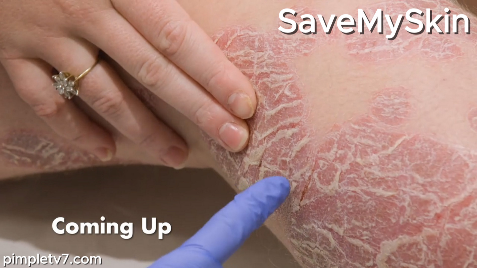 Emily’s itchy and painful psoriasis covers her entire body. SaveMySkin 190826