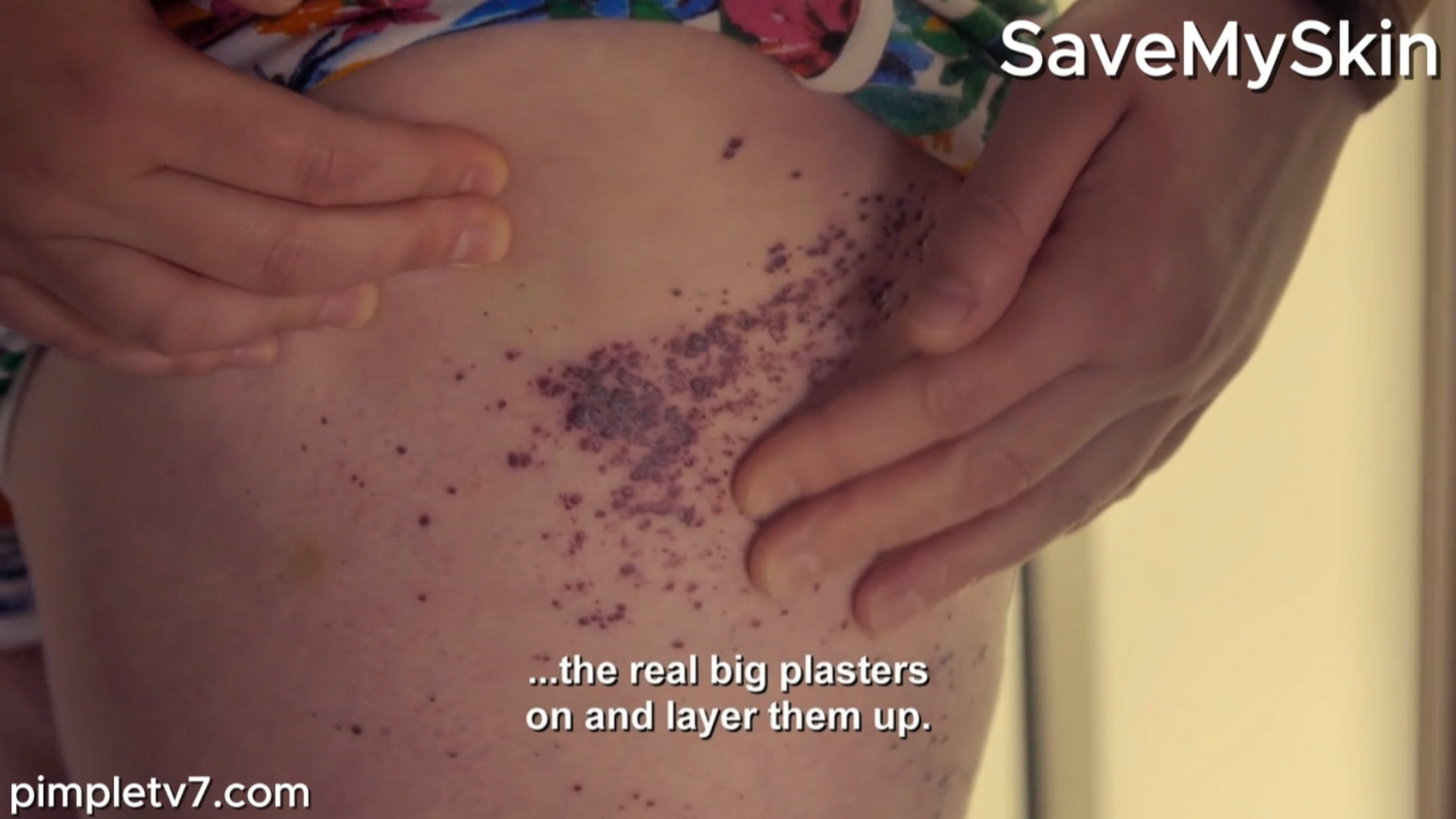 Emma’s rare skin condition continues to spread. SaveMySkin 040826