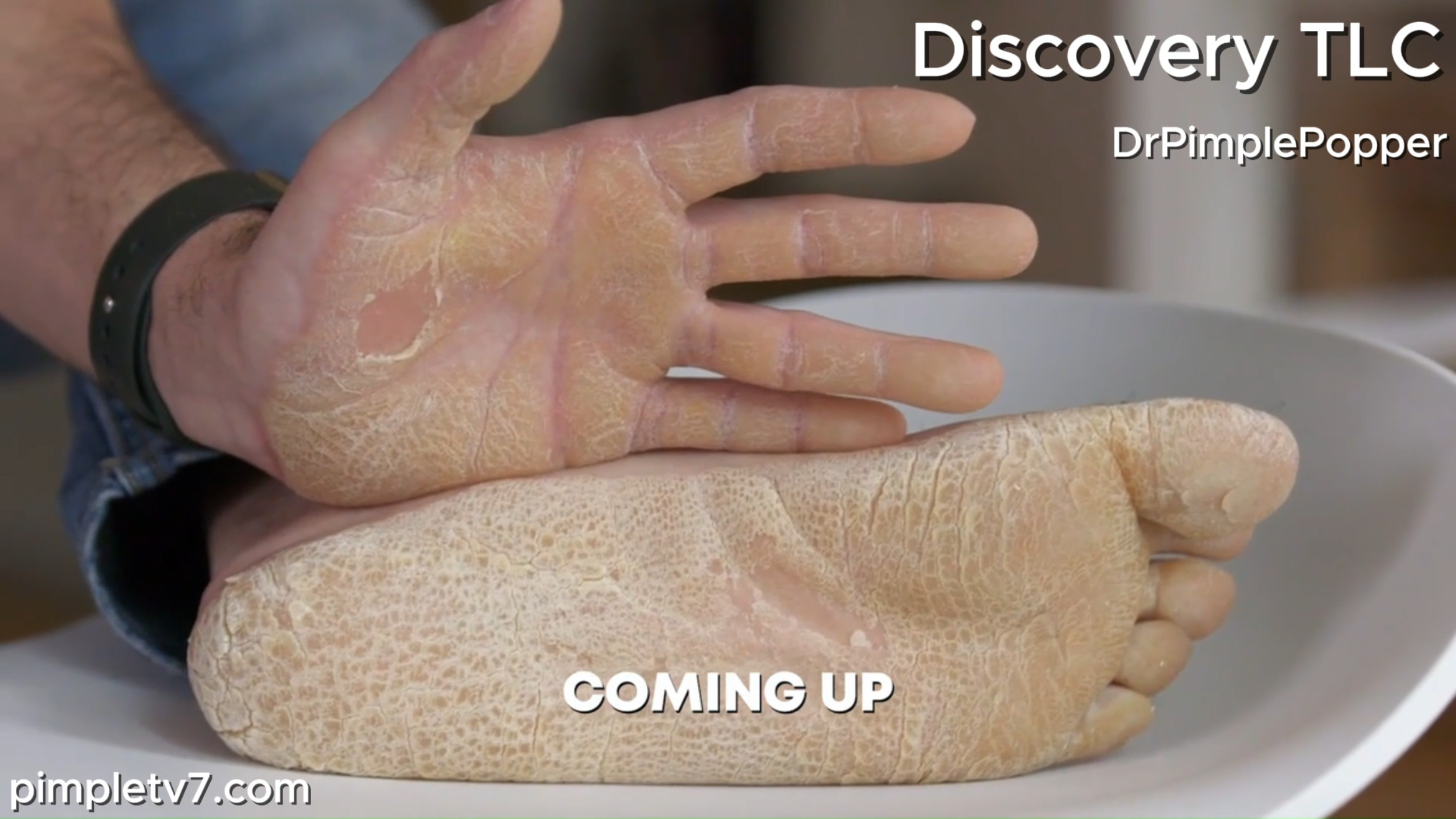 Felipe is a photographer with a dry skin condition so severe he risks losing his career. Dr. Pimple Popper 070826
