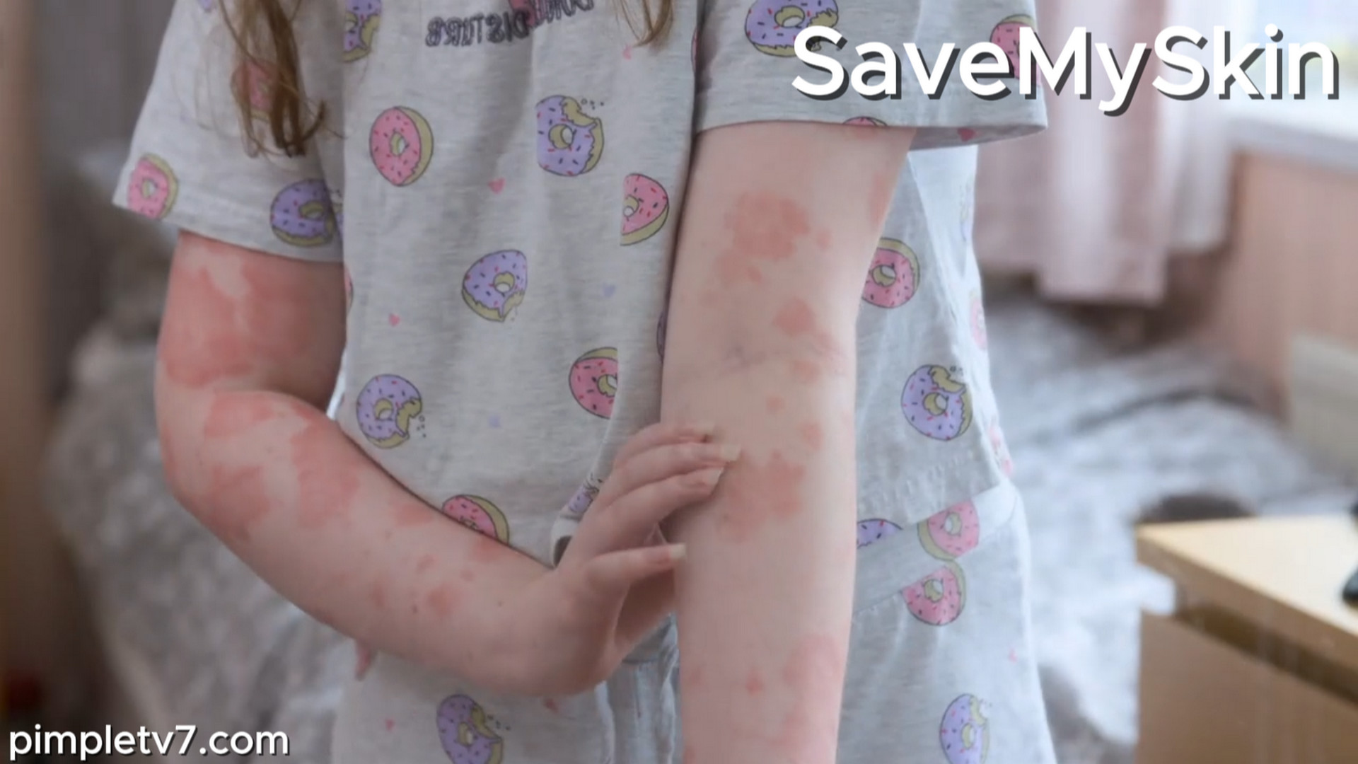 Fifteen-year-old Libby has a mysterious rash on her face and arms. SaveMySkin 260826
