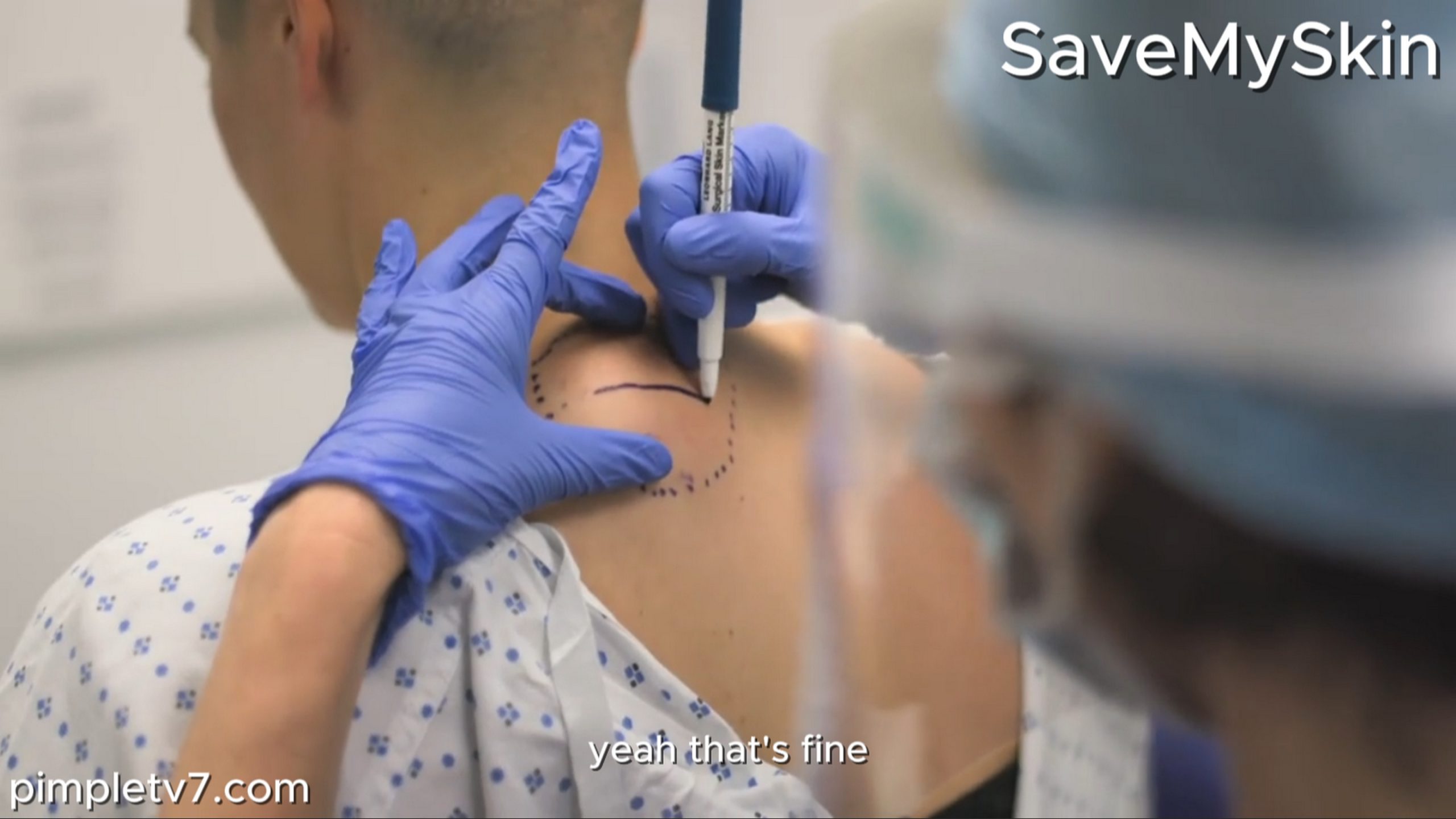 Figen has a painful lipoma on her neck. SaveMySkin 180826
