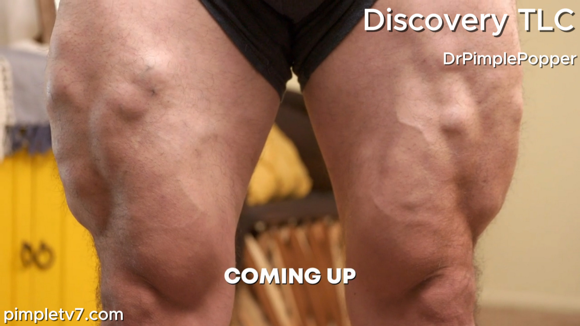 Fit guy Alonso wants to show off his progress in the gym, but his 70 lipomas are holding him back. Dr. Pimple Popper 040826
