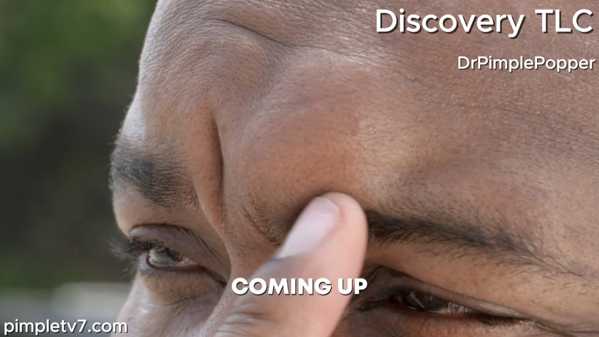 Former NFL defensive tackle Marcell Dareus hopes Dr. Lee can tackle his forehead lipoma. Dr. Pimple Popper 080826