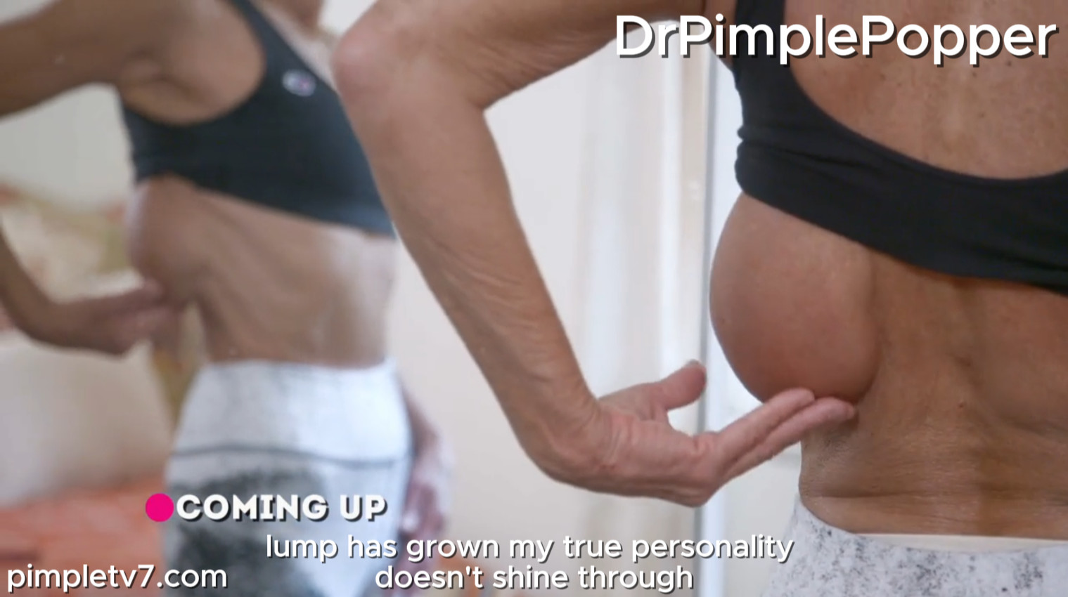 Former cruise ship worker Julie hopes Dr. Lee can remove her large back growth so she can return to the sea. Dr. Pimple Popper 030826