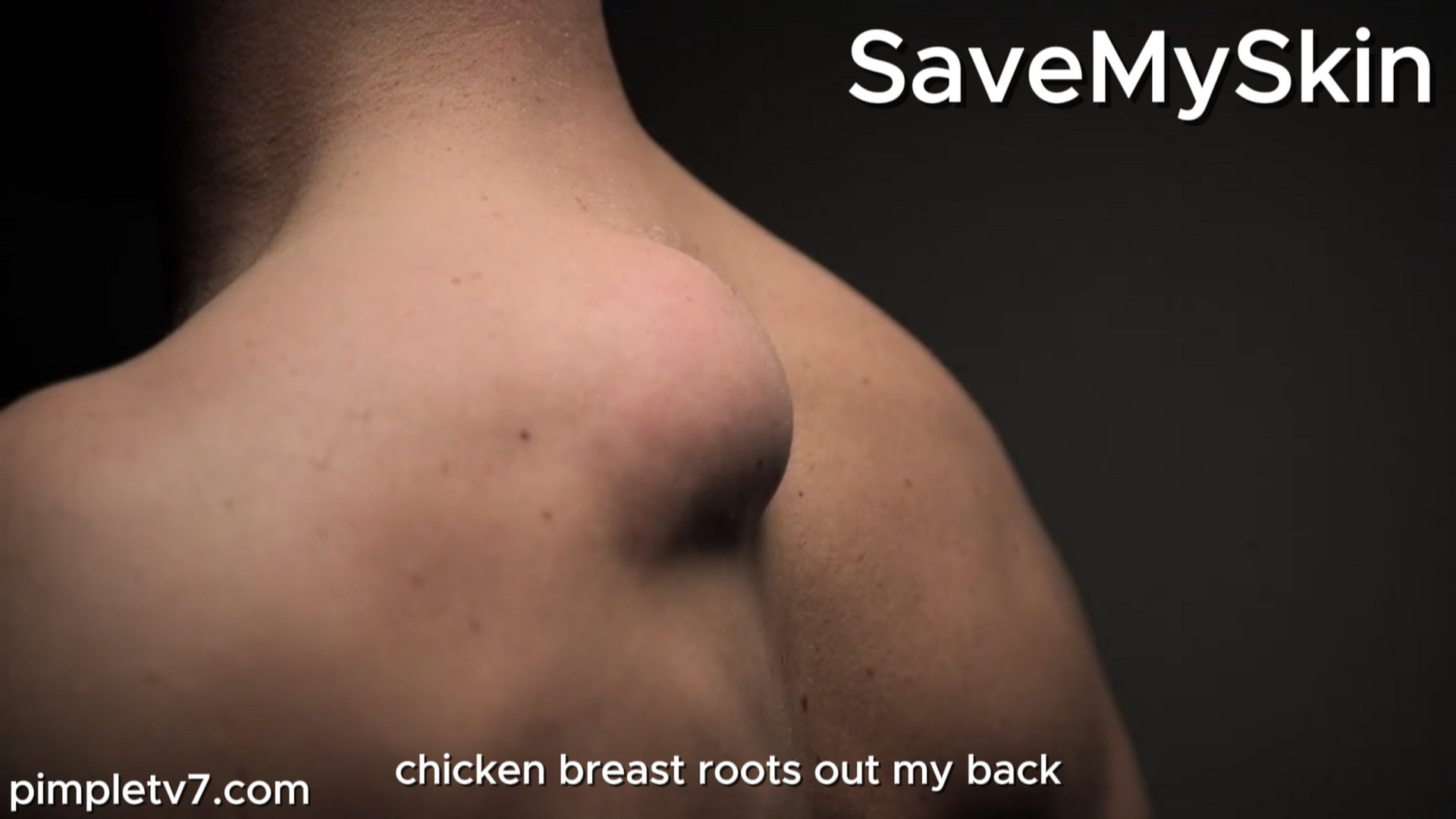 Former pro-wrestler Chris has a mass on his shoulder. SaveMySkin 180826