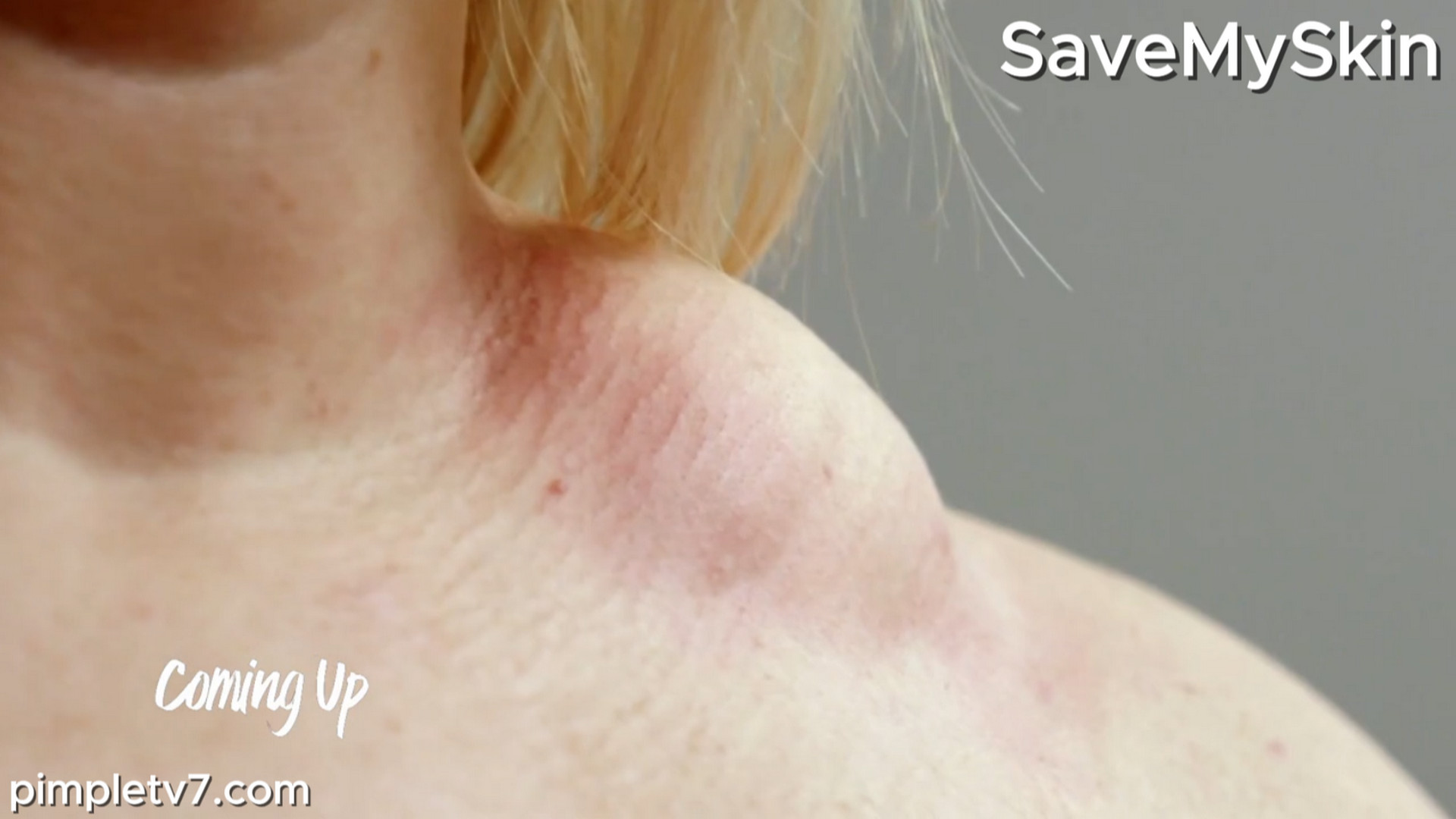 Gemma’s dream of having a baby is hampered by the lump on her shoulder. SaveMySkin 020826
