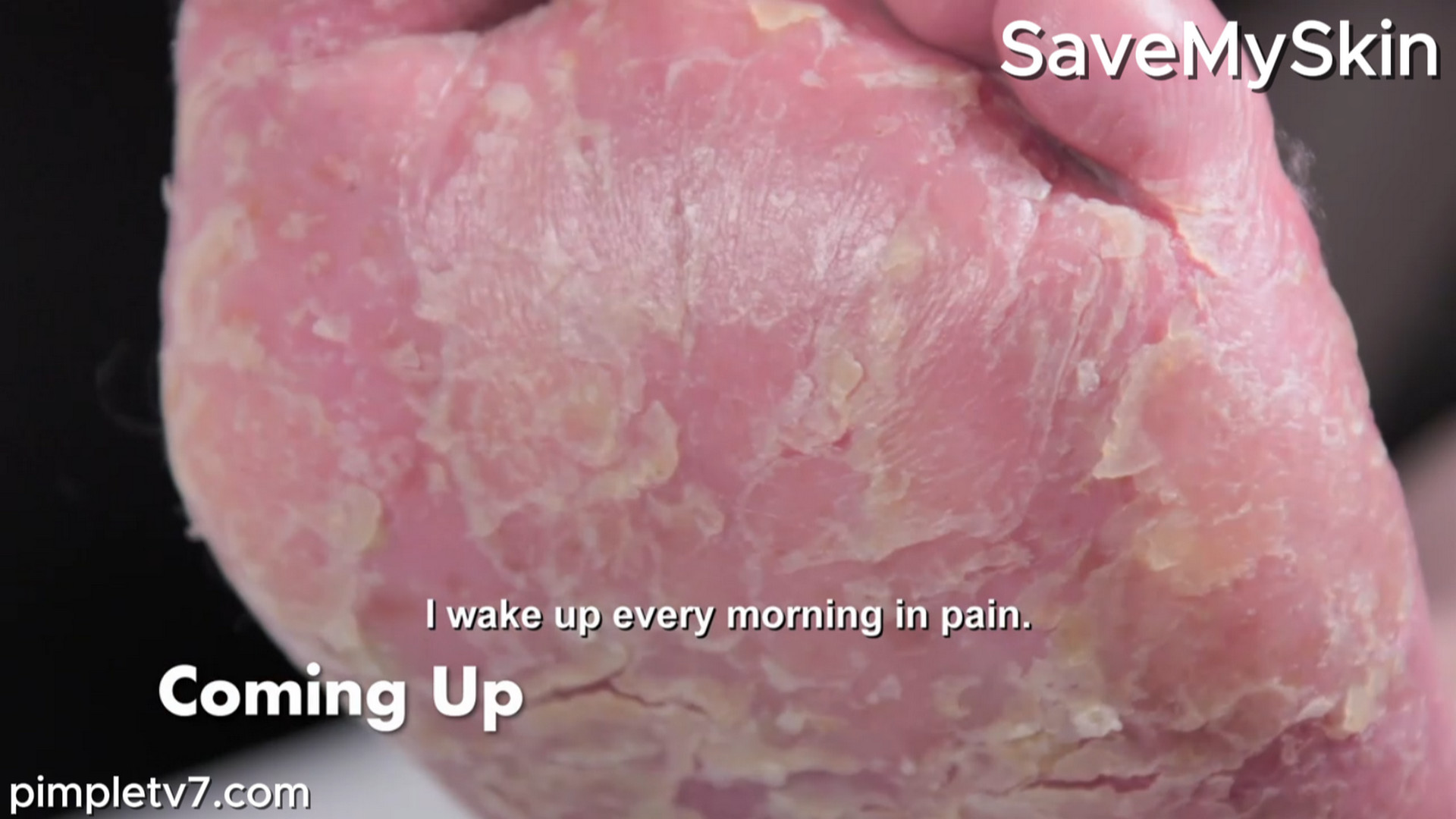 Georgia’s inflammatory skin condition has ruined her life. SaveMySkin 020826