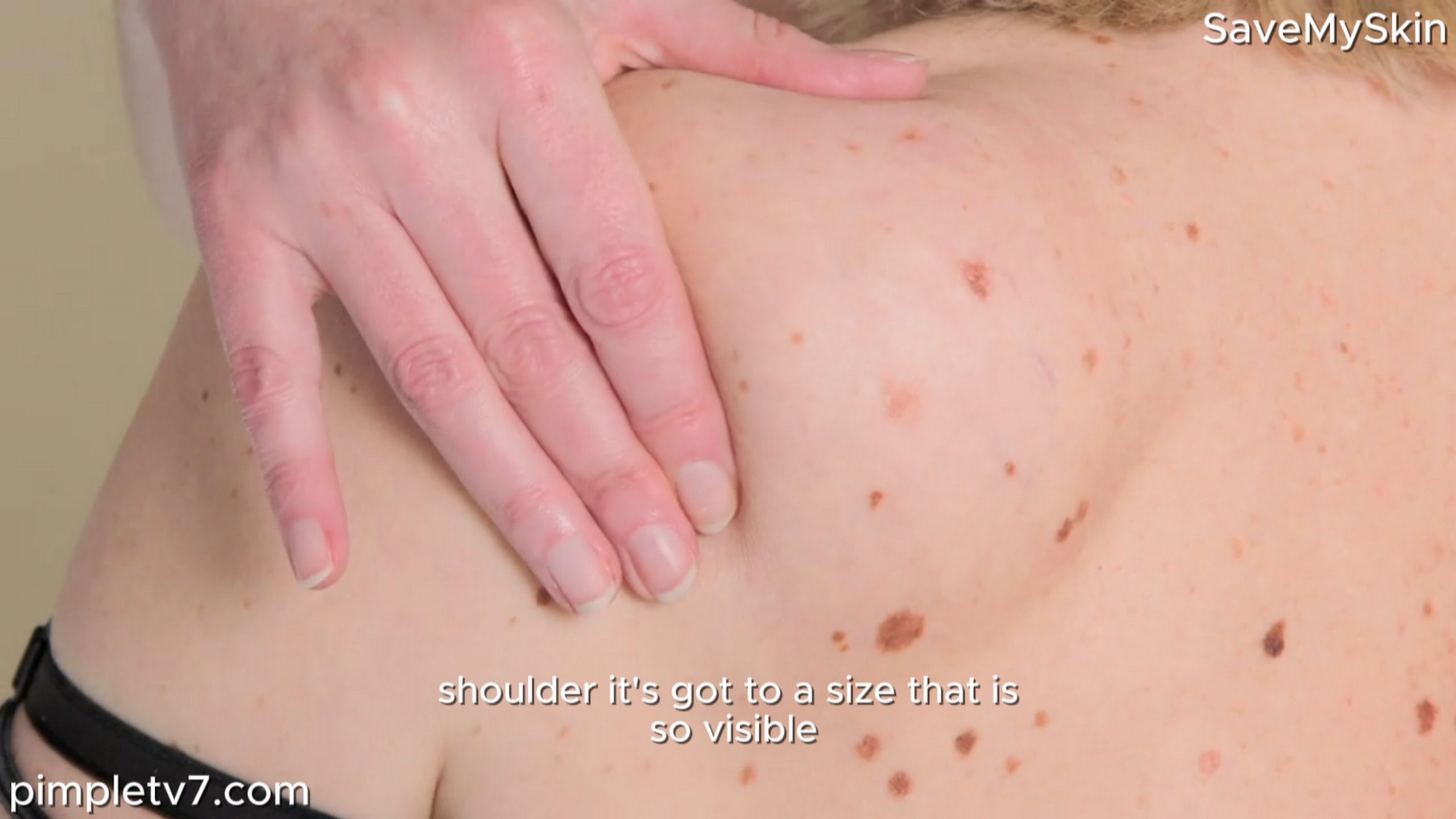 Gini elects to have a large lipoma removed. SaveMySkin 080826
