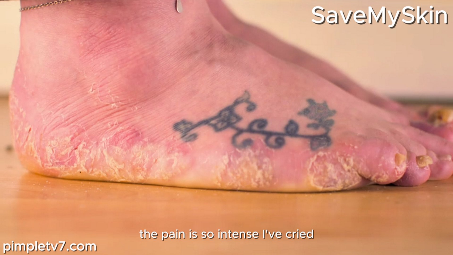 Hannah’s hands and feet are covered in blisters. SaveMySkin 220826