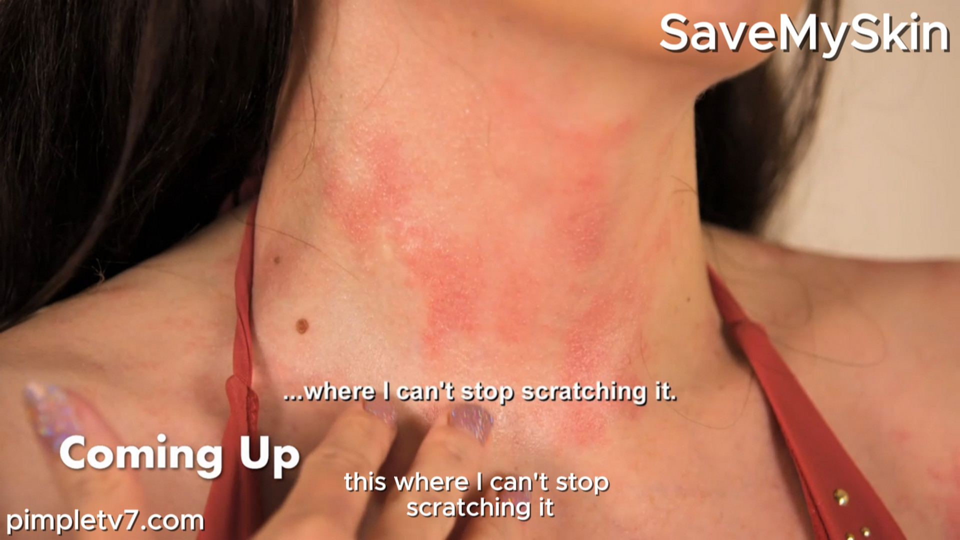 Hannah’s rash is unpredictable and painful. SaveMySkin 230826